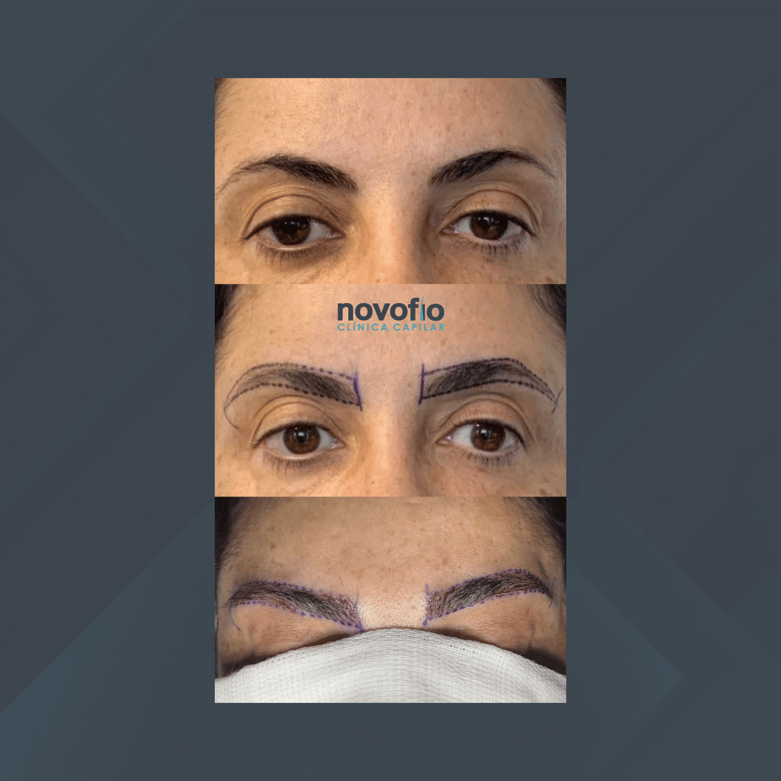 Novofio Curitiba. Implante de Sobrancelhas. #1.1
