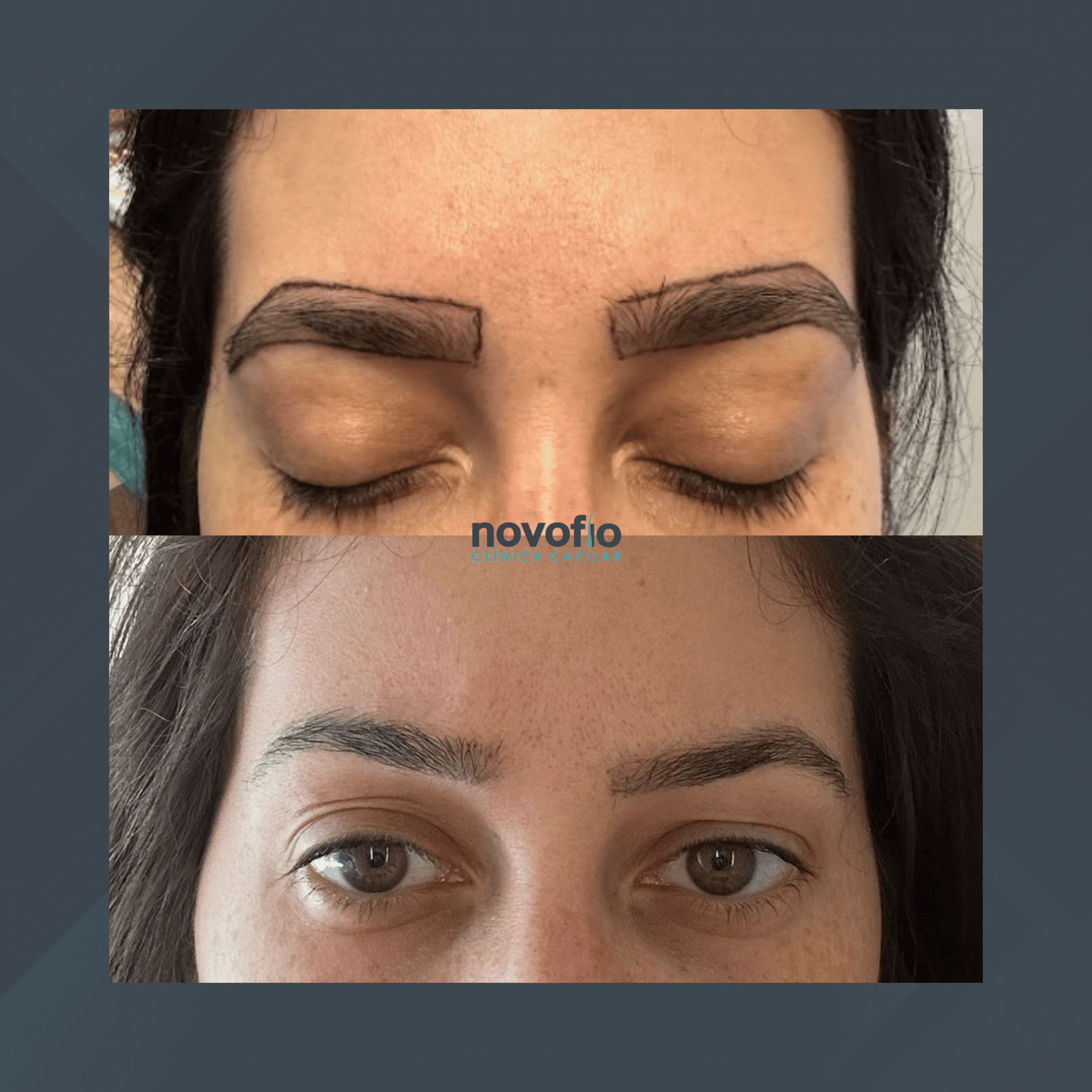 Novofio Curitiba. Implante de Sobrancelhas. #2.1