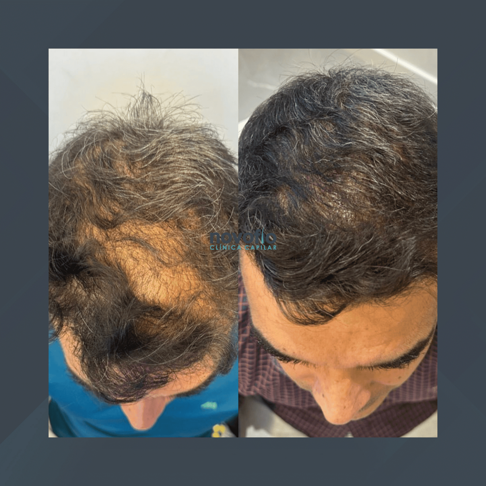 Novofio Curitiba. Mesoterapia. #1.1