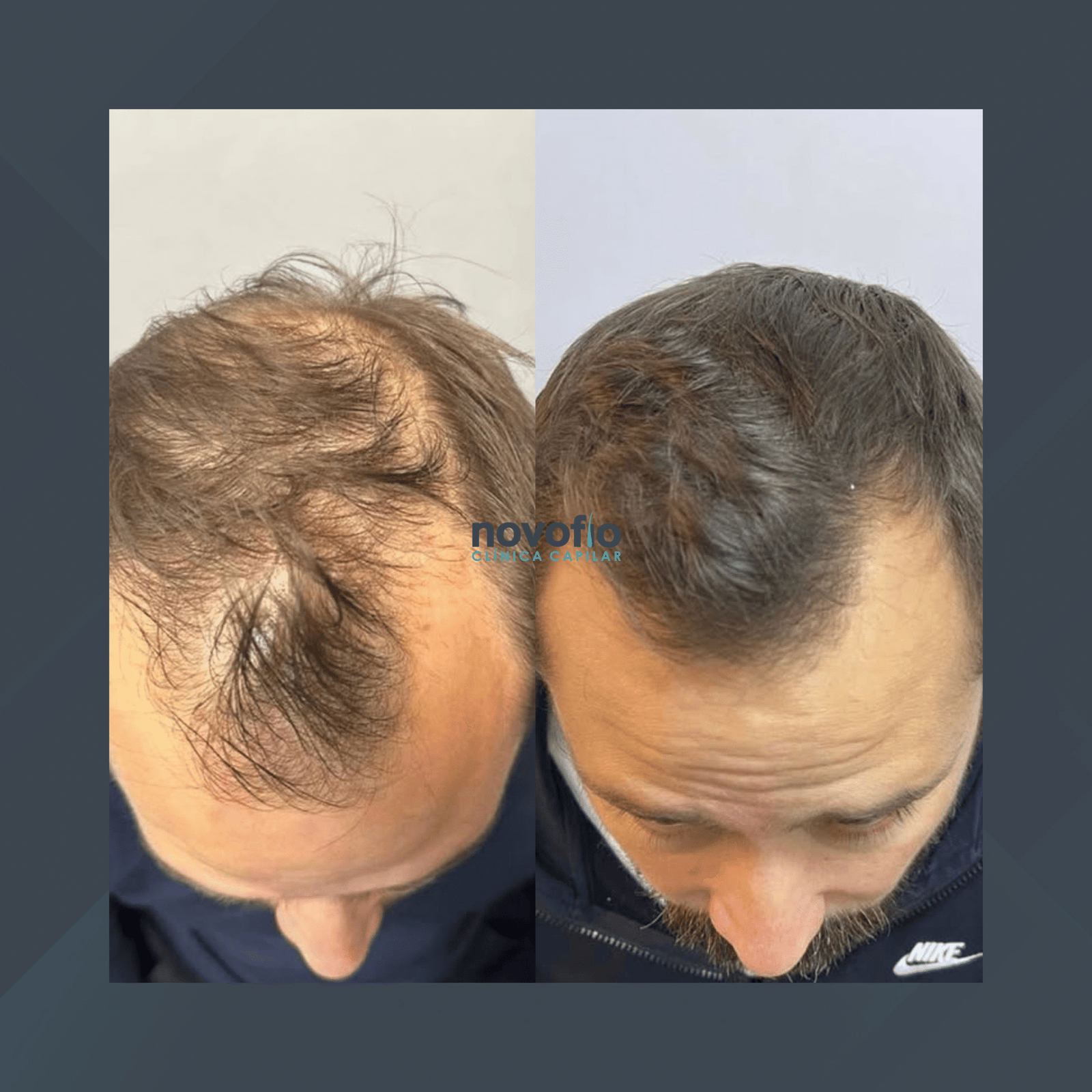 Novofio Curitiba. Mesoterapia. #2.1