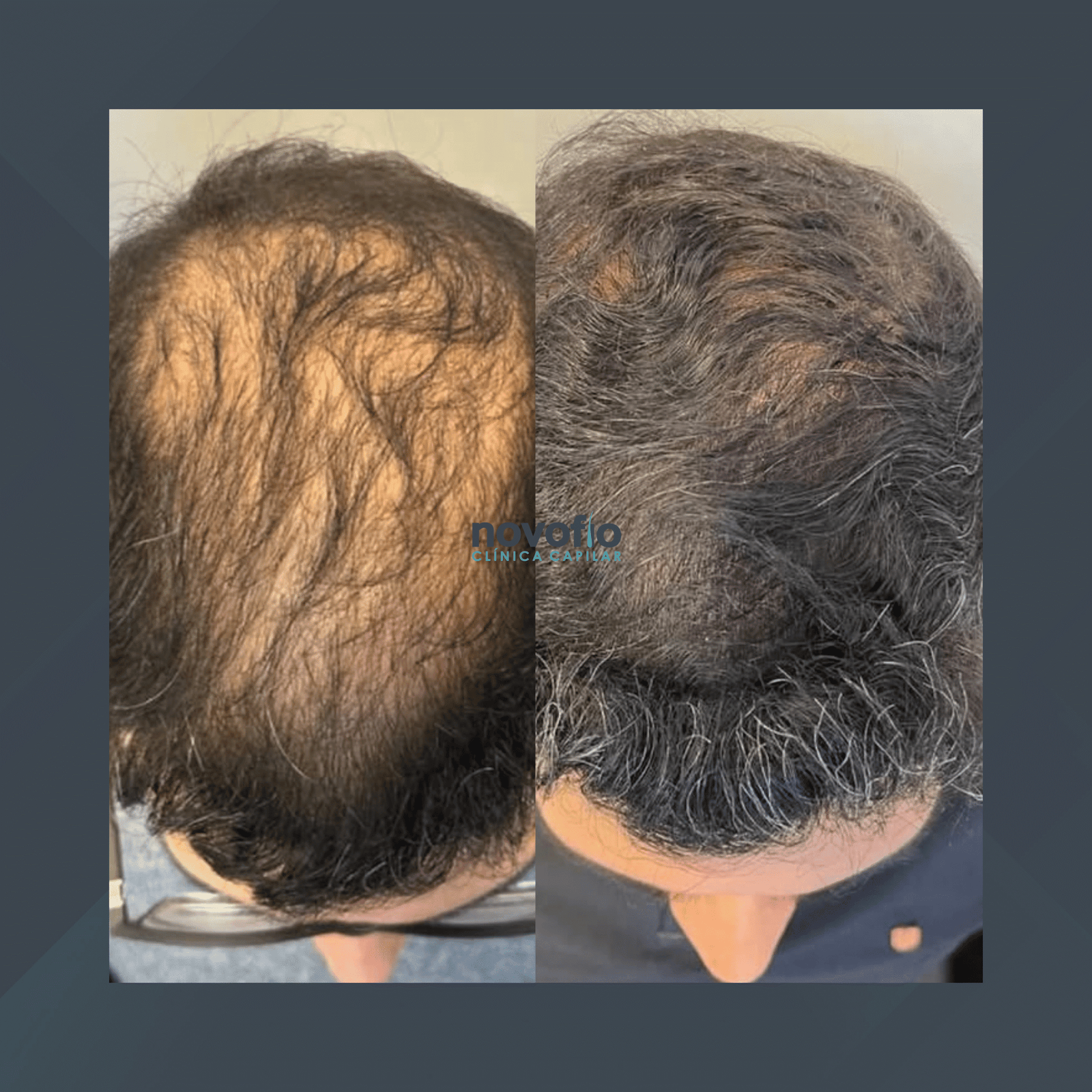 Novofio Curitiba. Mesoterapia. #3.1