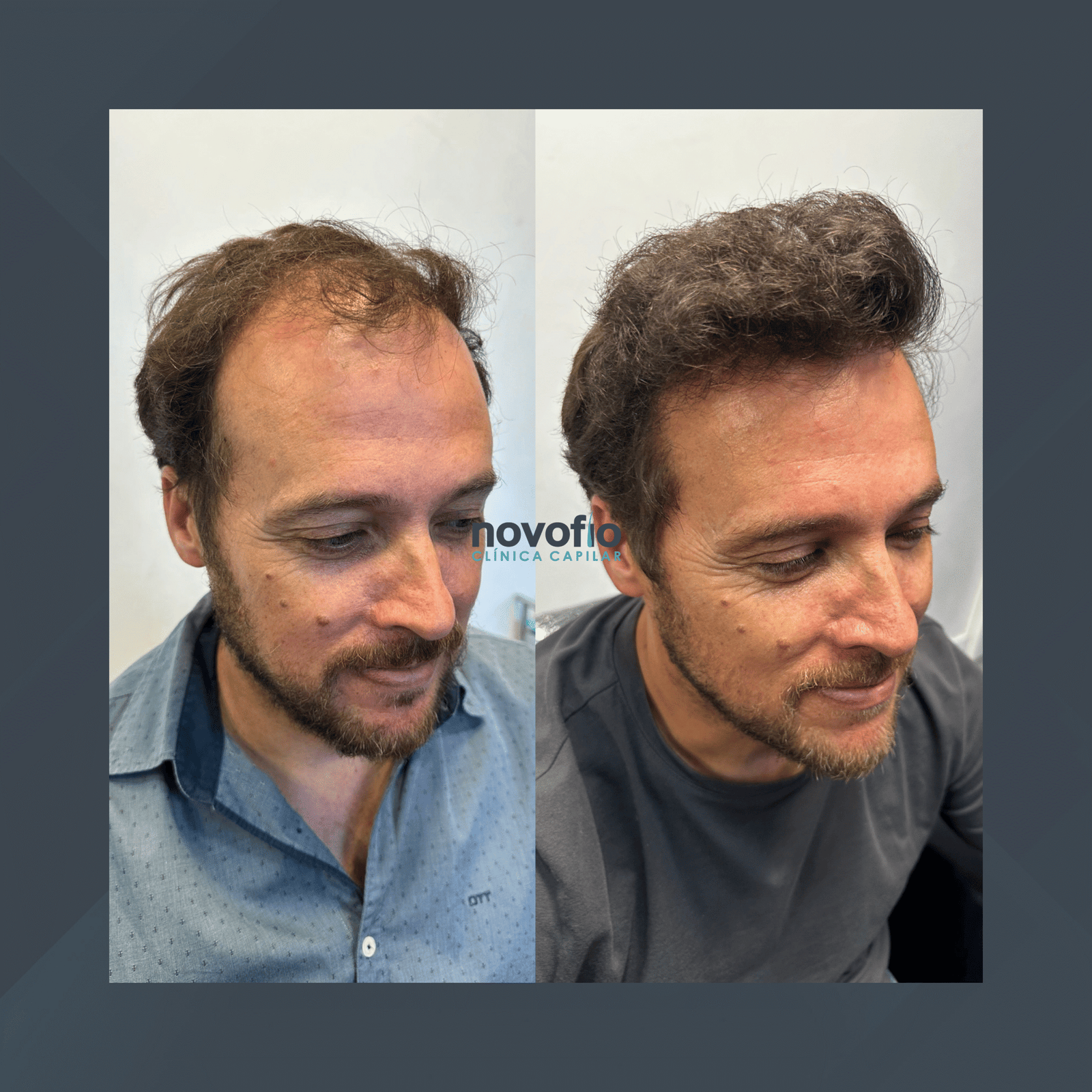 Novofio Curitiba. Transplante Capilar Masculino. #1.1
