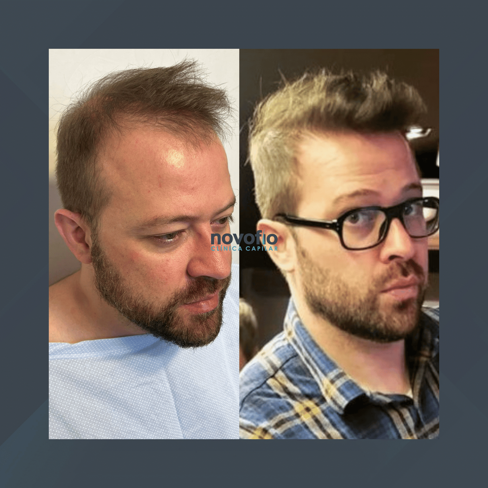 Novofio Curitiba. Transplante Capilar Masculino. #2.1