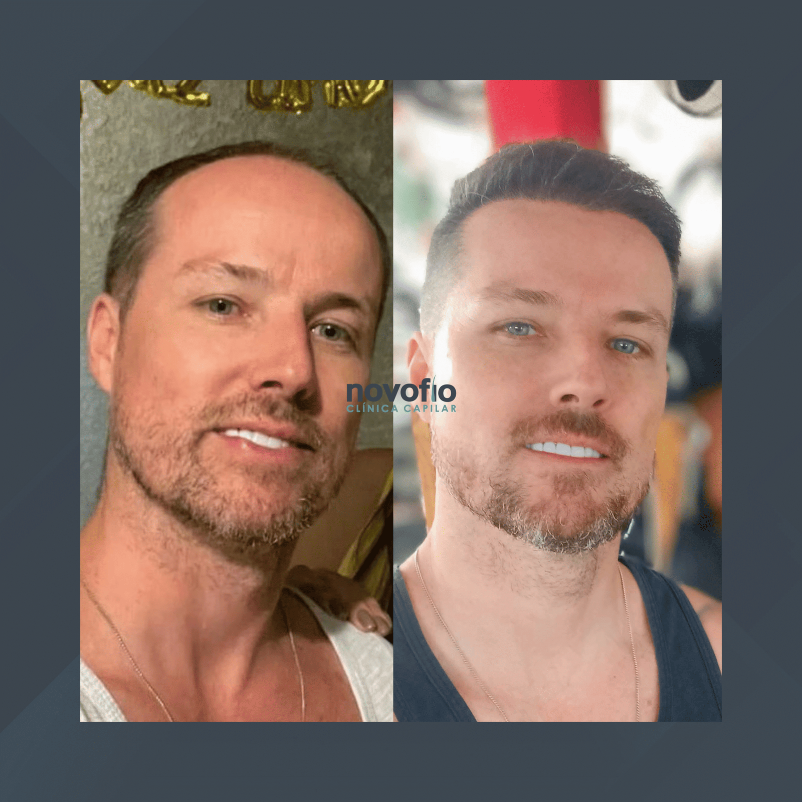 Novofio Curitiba. Transplante Capilar Masculino. #3.1