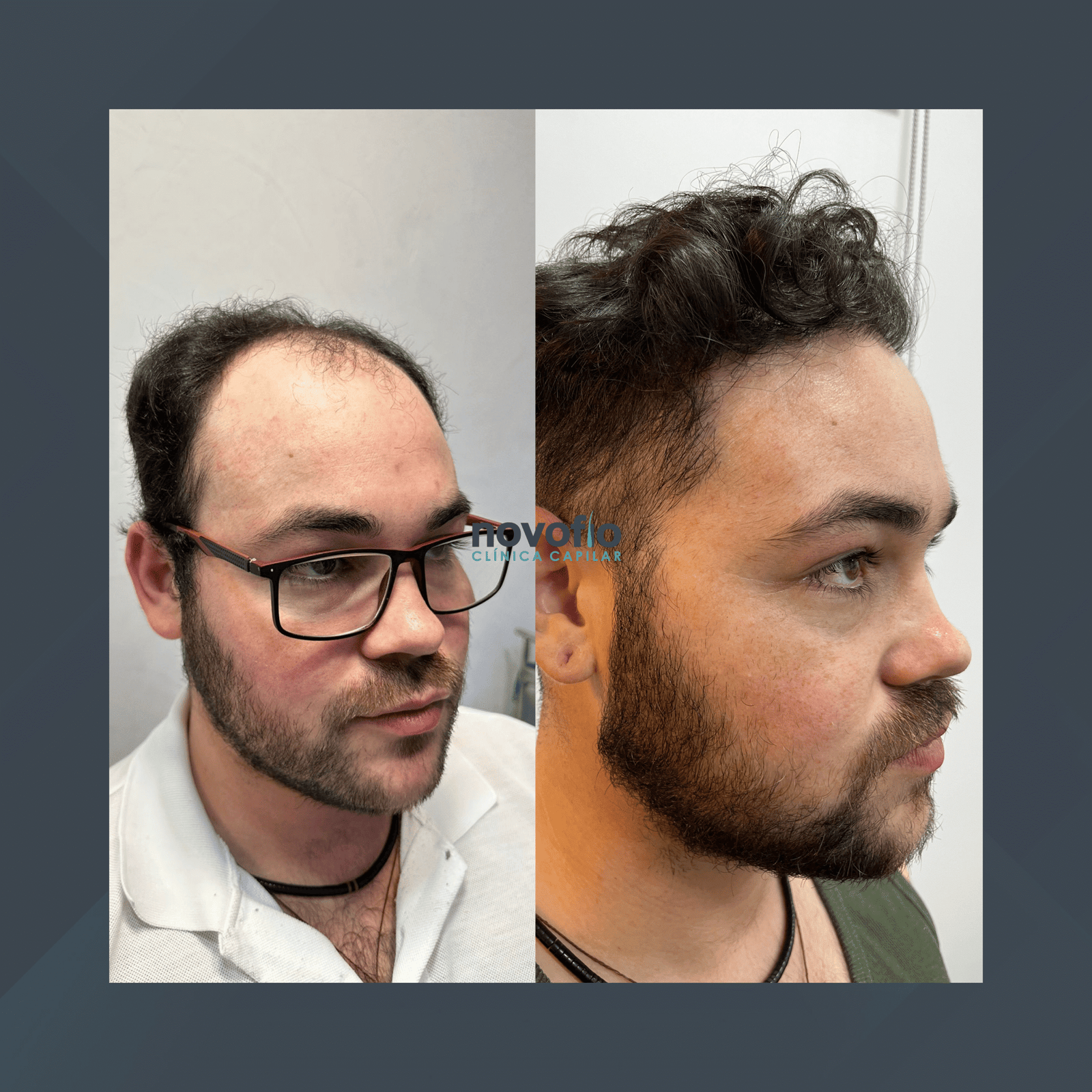 Novofio Curitiba. Transplante Capilar Masculino. #4.1