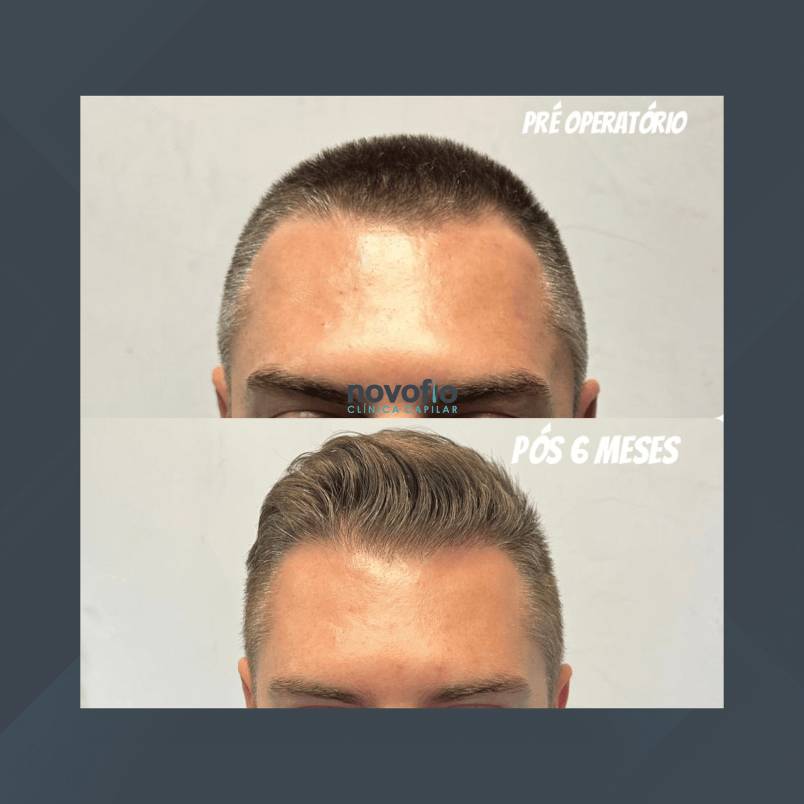 Novofio Curitiba. Transplante Capilar Masculino. #6.1