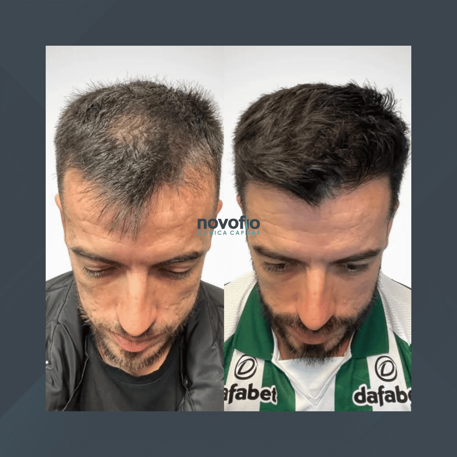 Novofio Curitiba. Transplante Capilar Masculino. #8.1