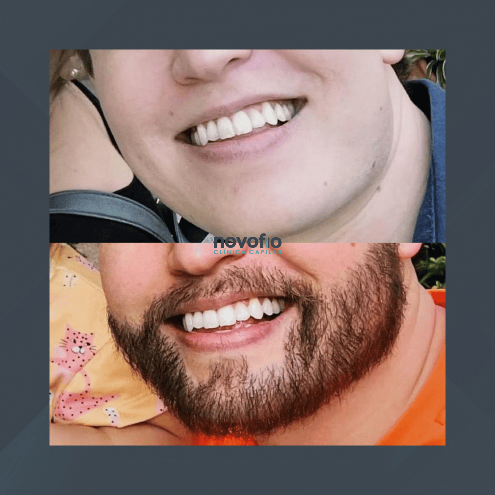 Novofio Curitiba. Transplante de Barba. #2.1