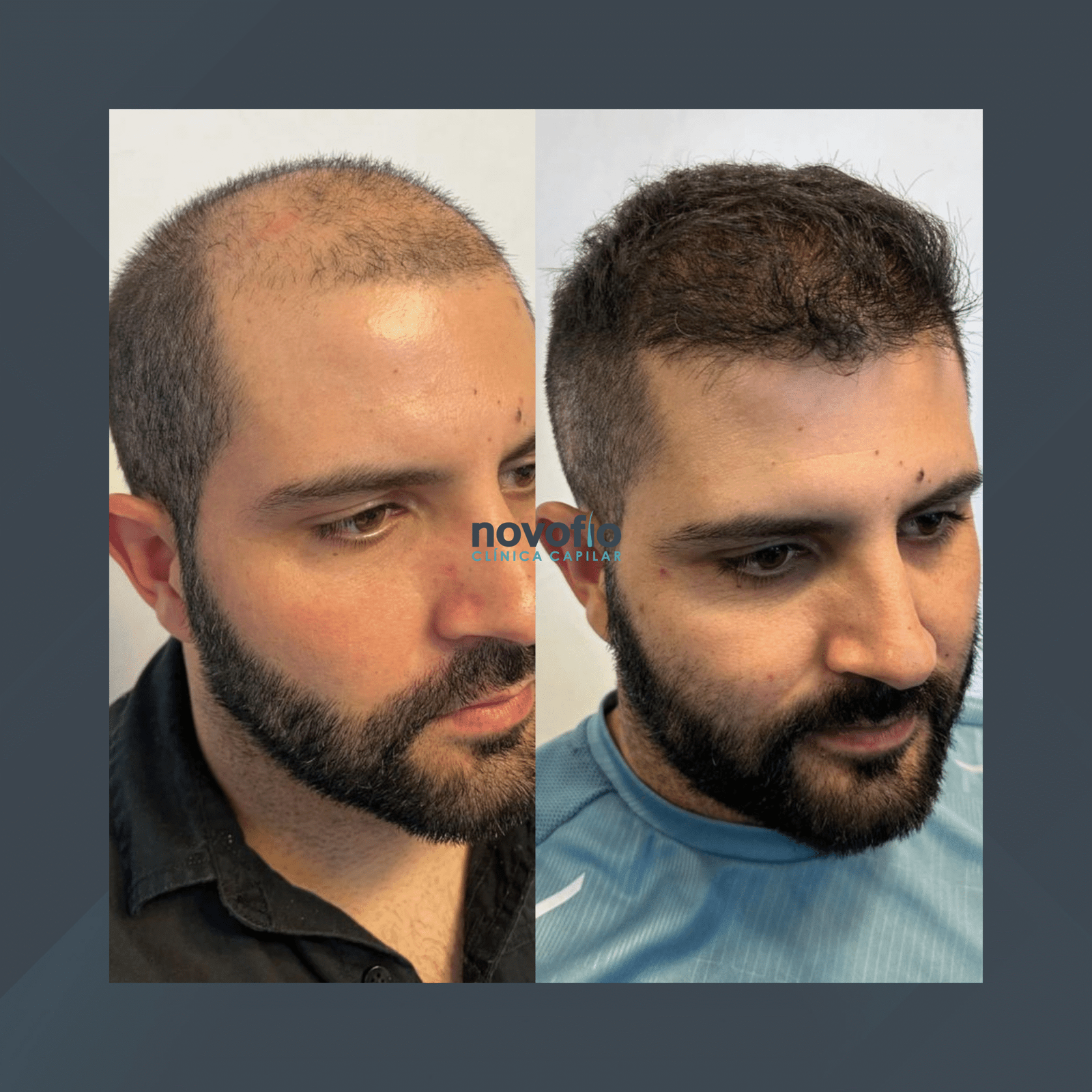 Novofio Curitiba. Transplante Capilar Masculino. #5.1