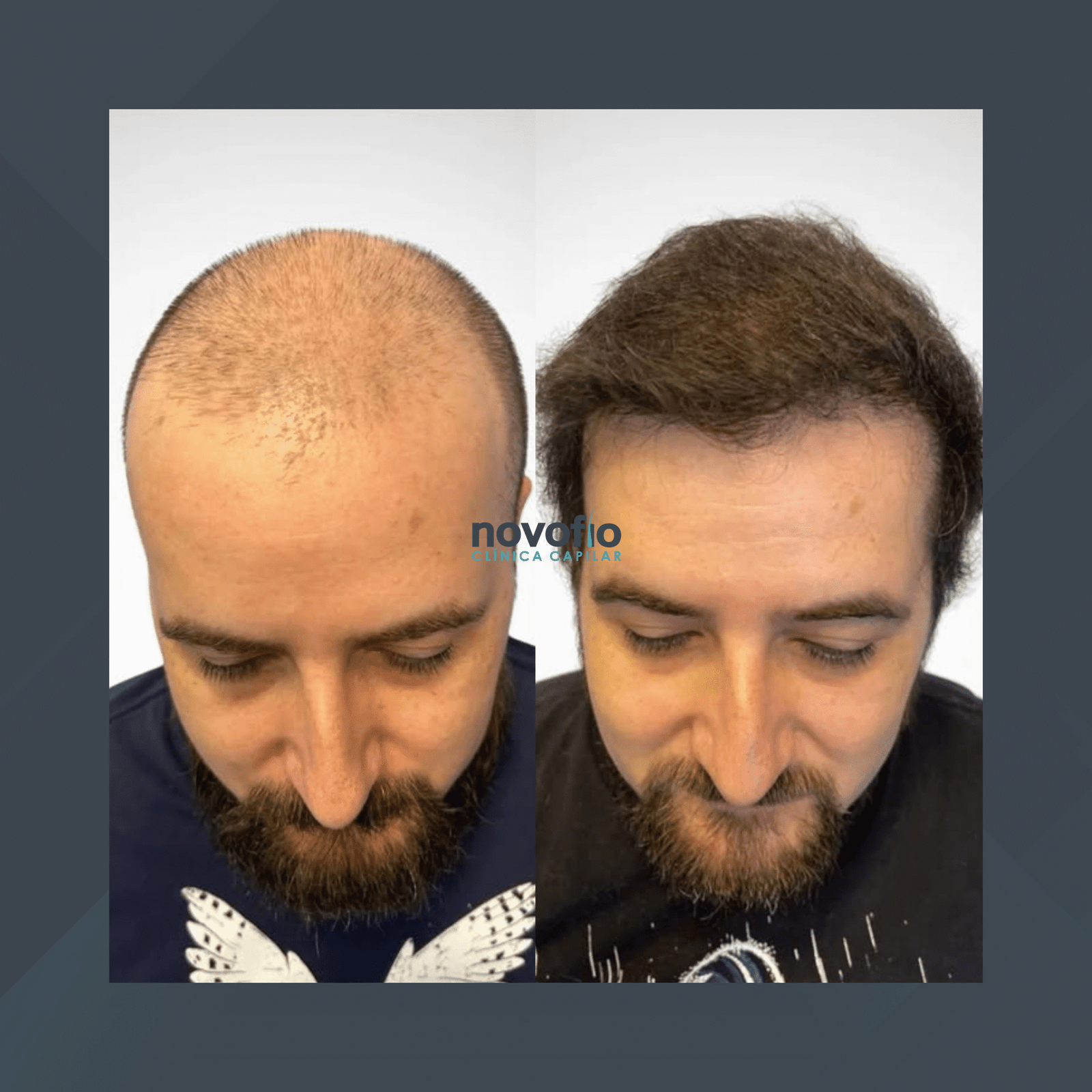 Novofio Curitiba. Transplante Capilar Masculino. #7.1