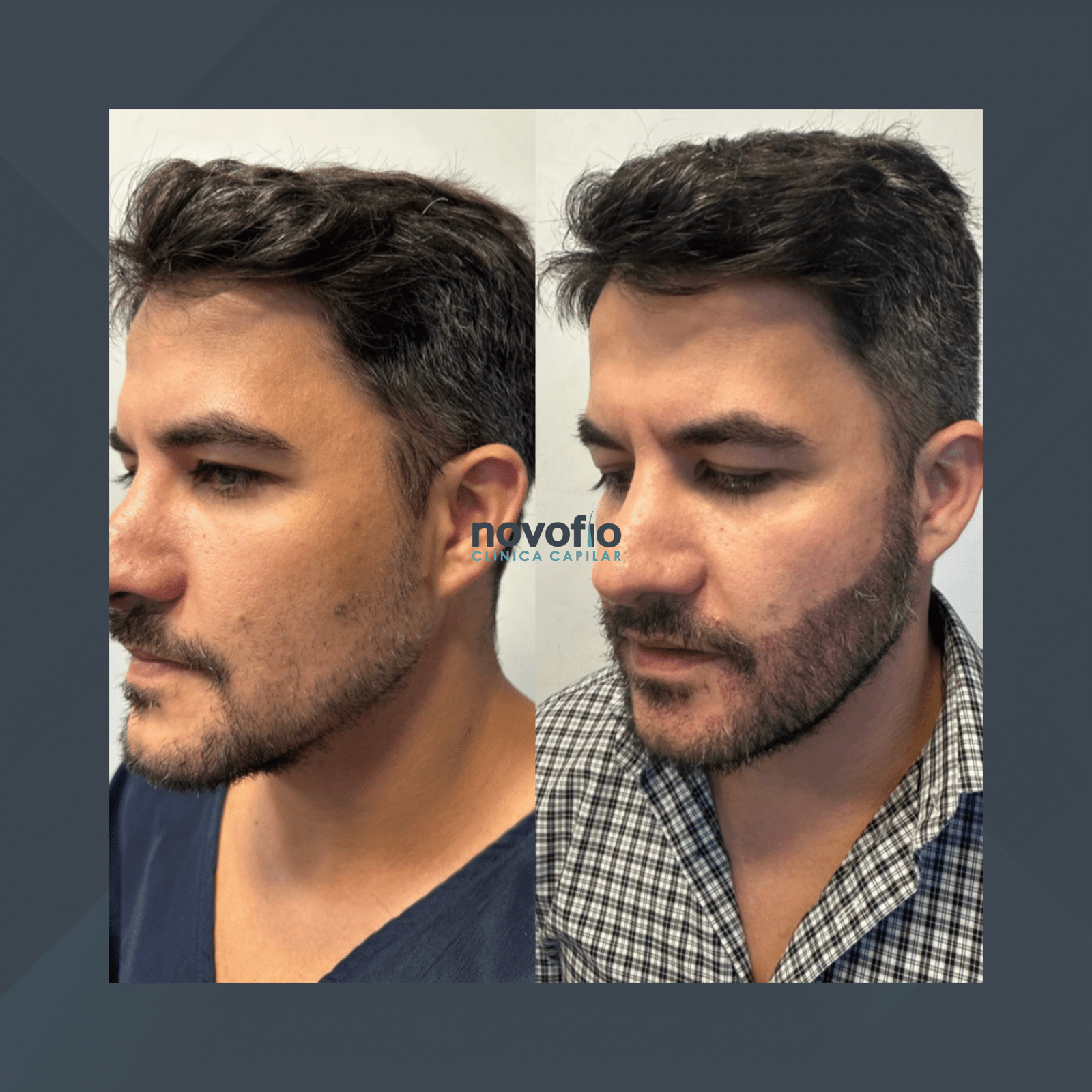 Novofio Curitiba. Transplante de Barba. #1.1