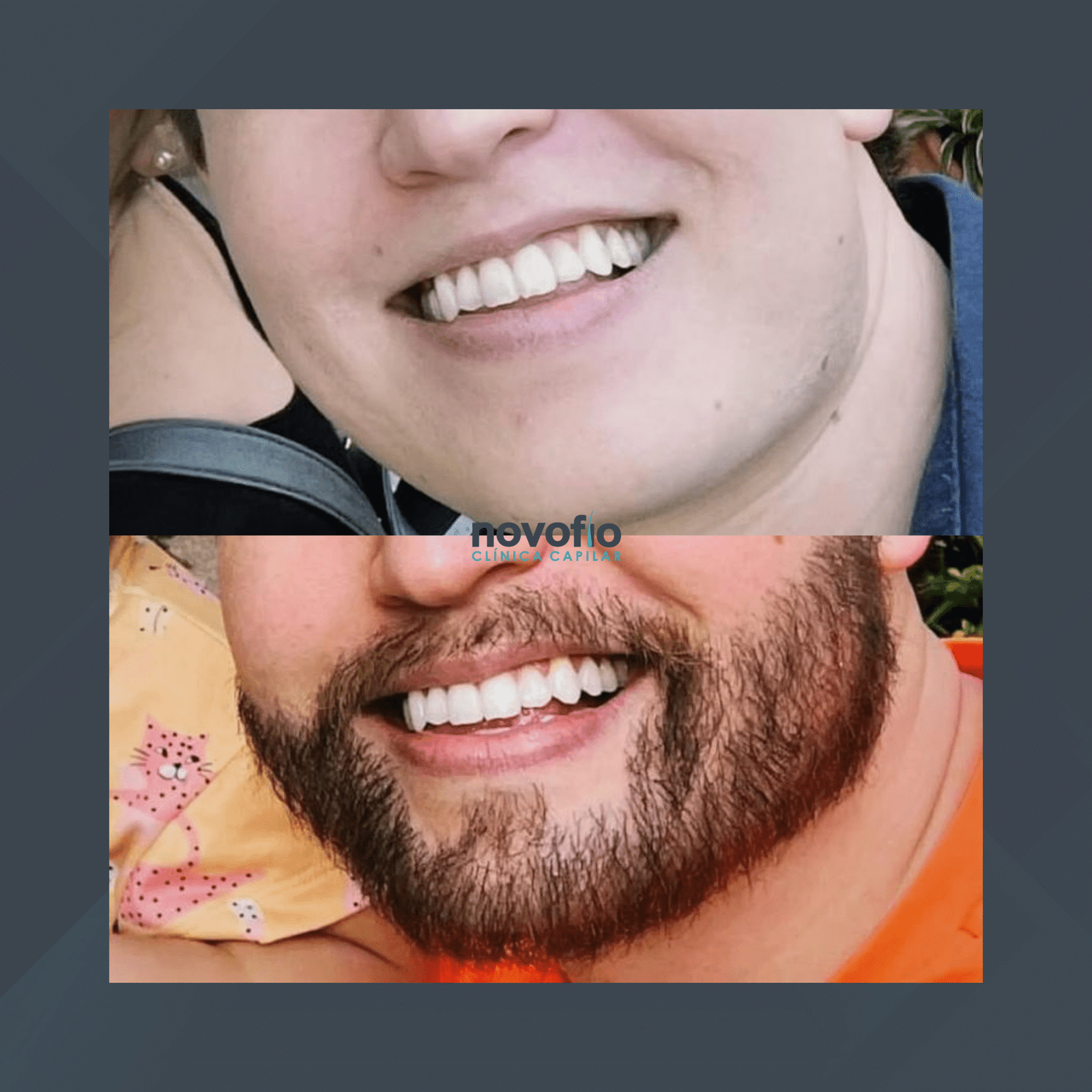 Novofio Curitiba. Transplante de Barba. #2.1
